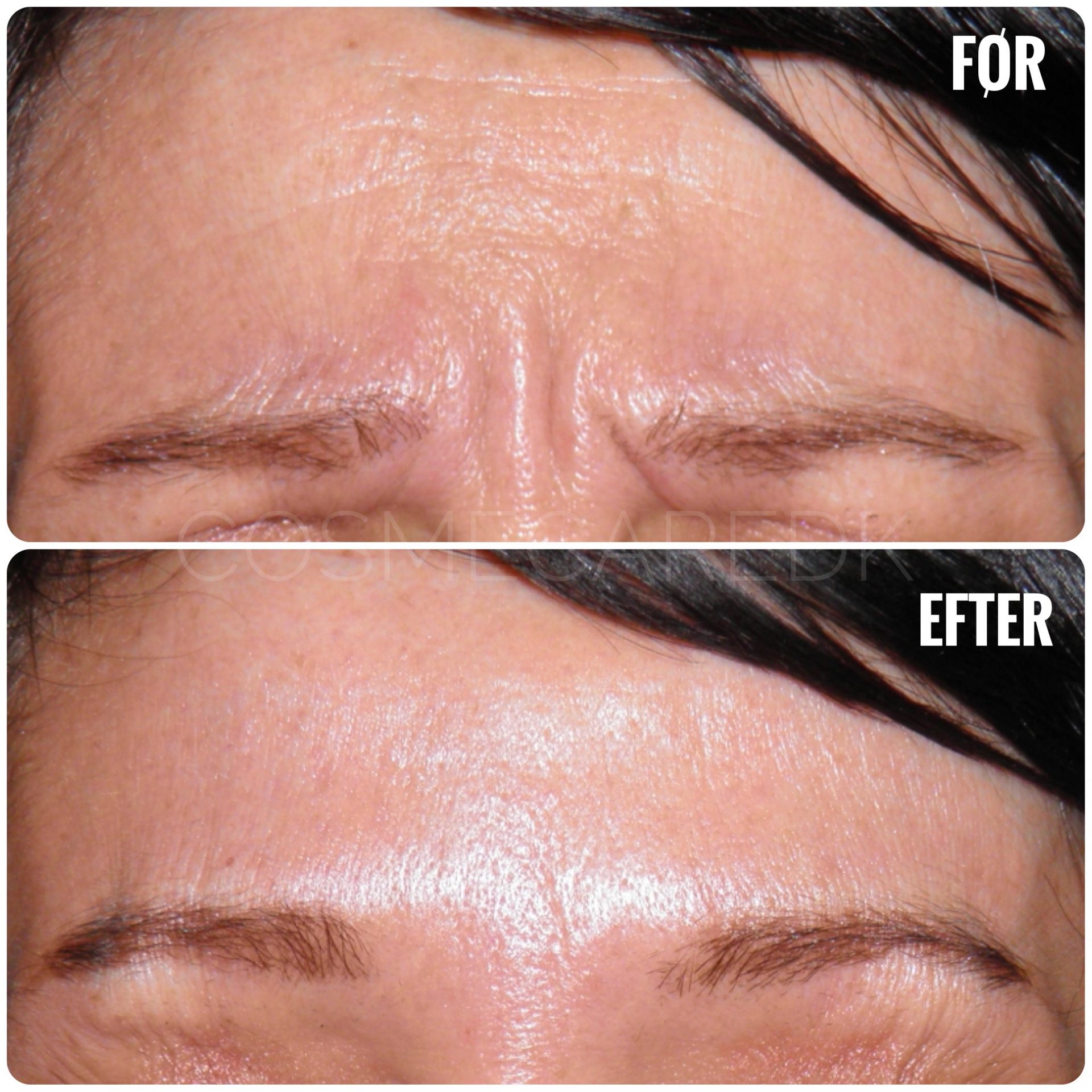 Før og efter botox - Rynkede bryn
