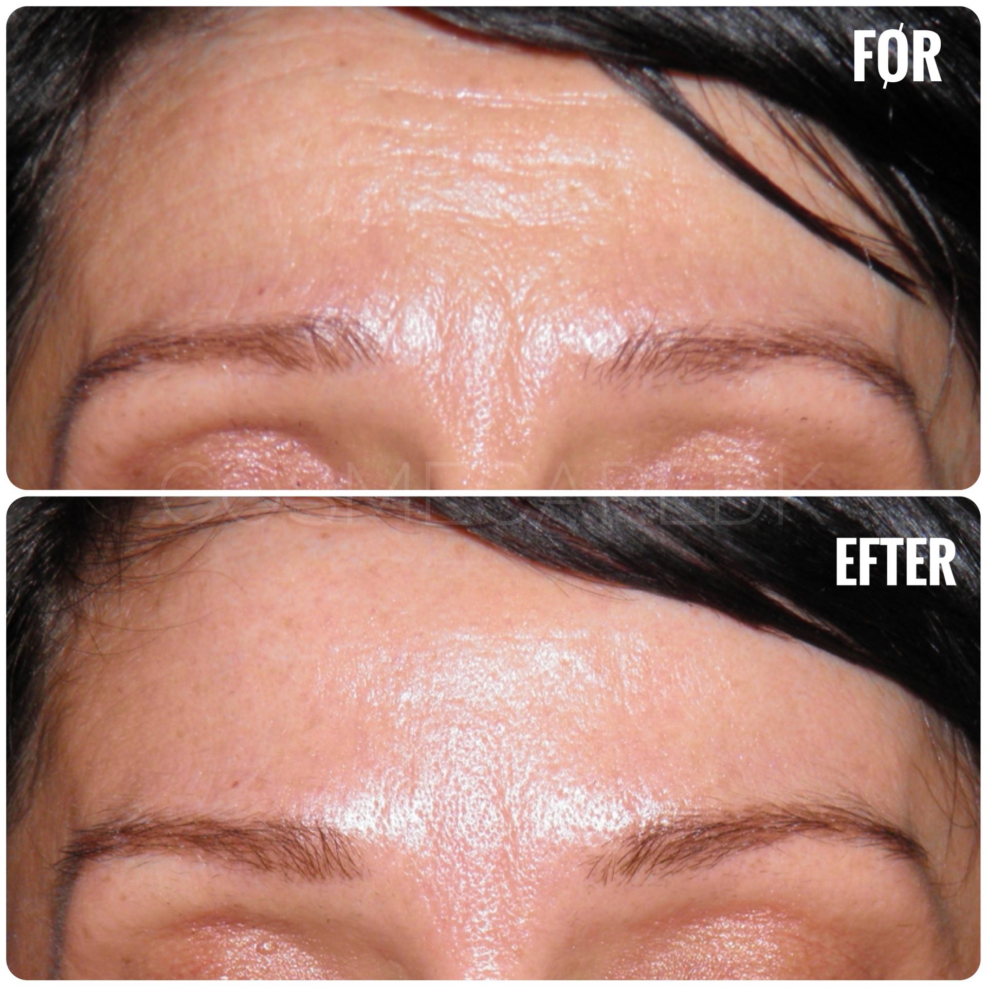 Før og efter botox - Neutrale bryn